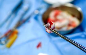  Prélèvement de sang au cordon pour bilan infectieux, faisable et fiable