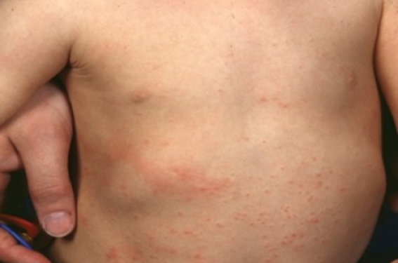 La Dermatite Atopique du nourrisson et du jeune enfant : Les enjeux pour les sages-femmes La Dermatite Atopique du nourrisson et du jeune enfant : Les enjeux pour les sages-femmes