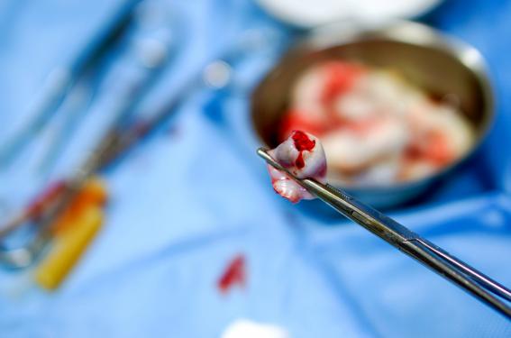 Prélèvement de sang au cordon pour bilan infectieux, faisable et fiable Prélèvement de sang au cordon pour bilan infectieux, faisable et fiable