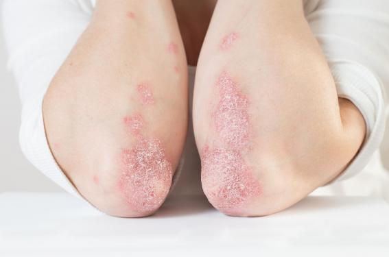 Quelle gestion en pratique du traitement du psoriasis pendant la grossesse ? Quelle gestion en pratique du traitement du psoriasis pendant la grossesse ?